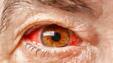 وباء العين الوردية "الرمد" يجتاح أجزاء من آسيا ويصيب الآلاف يوميا